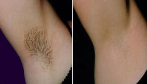 Armpit Hair Removal Before & After