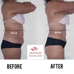 Coolsculpting Vancouver