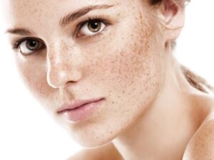Skin Pigmentation Vancouver Star Laser Centre