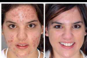 Acne Removal Before After
